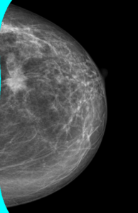 Mamografía cráneo-caudal de mama