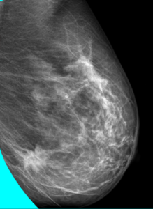 Mamografía OML de mama