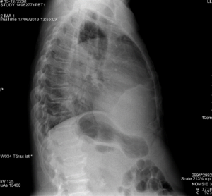 Radiografía de tórax (visón lateral)