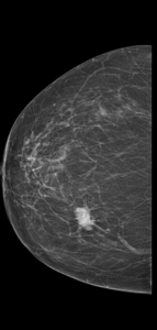 Mamografía frontal de la mama derecha