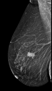 Mamografía oblicua de la mama derecha