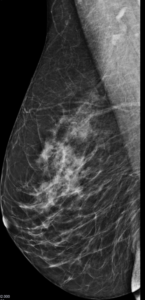 Mamografía OML