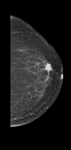 mamografía de mama