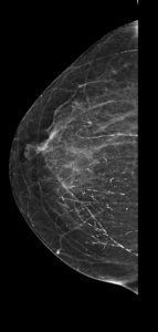 mamografia de mama