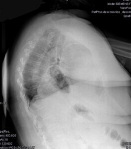 Radiografía simple de tórax (Lateral)