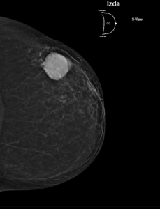 Mamografía con tomosíntesis mama izquierda (CC)