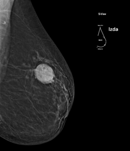 Mamografía con tomosíntesis mama izquierda (OML)
