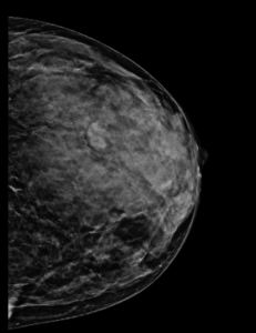 Mamografía mama izquierda