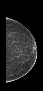 Mamografía CC MI