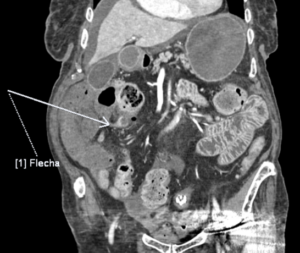TC (ventana de partes blandas) coronal de abdomen
