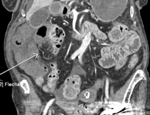 TC (ventana de partes blandas) coronal del abdomen