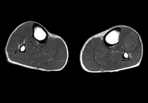 RNM axial T1