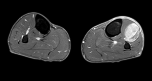 RNM axial DP (densidad protónica) 