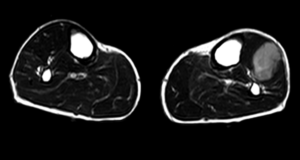 RNMN axial T2