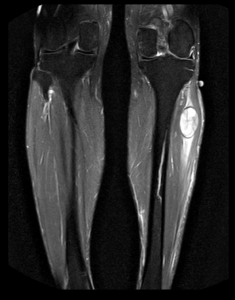 RNM coronal DP