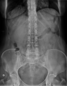 Rx AP de abdomen 