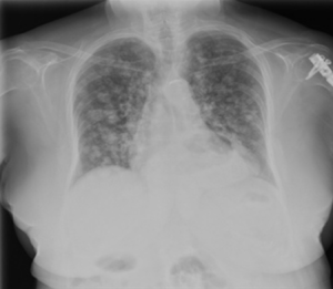 Radiografía de tórax poteroanterior