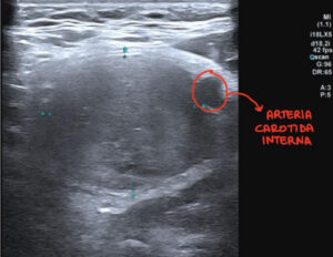 Ecografía cervical