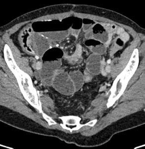 (TC abdomen)