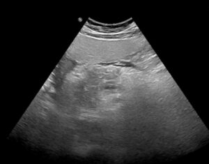 Ecografía abdominal