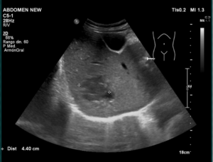 Ecografía abdominal