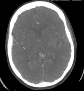 AngioTC craneal