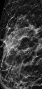 Mamografía medio lateral oblicua de mama izquierda