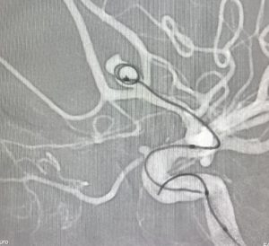 Angiografía cerebral del polígono de Willis