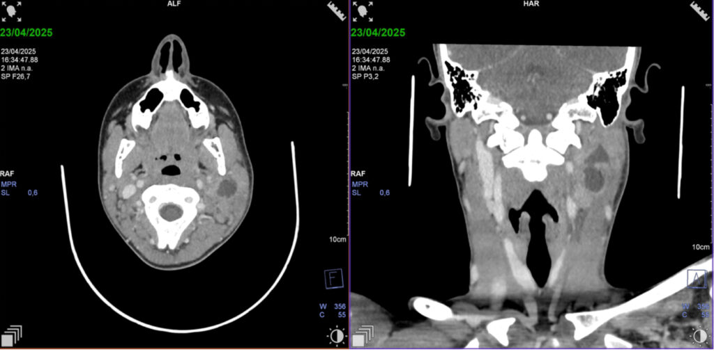 TC cervical