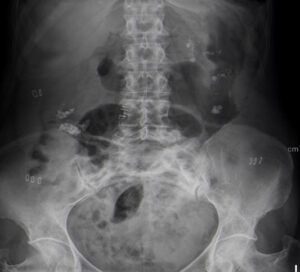 RX AP de Abdomen