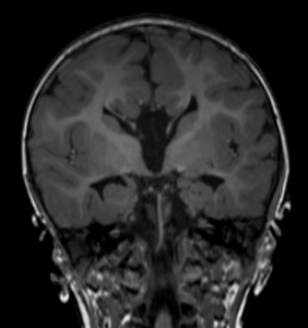 RM cerebral