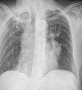 Rx PA de tórax