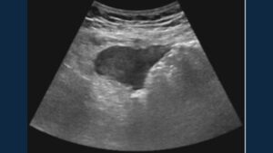Ecografía abdominal