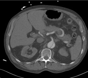 TC abdominal