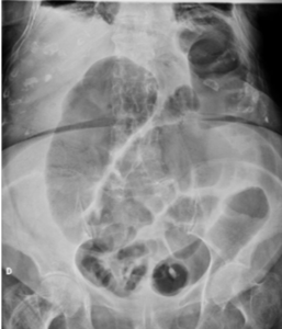 Radiografía simple de abdomen.