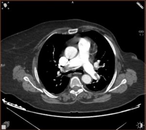 Angio-TC de arterias pulmonares (corte axial)